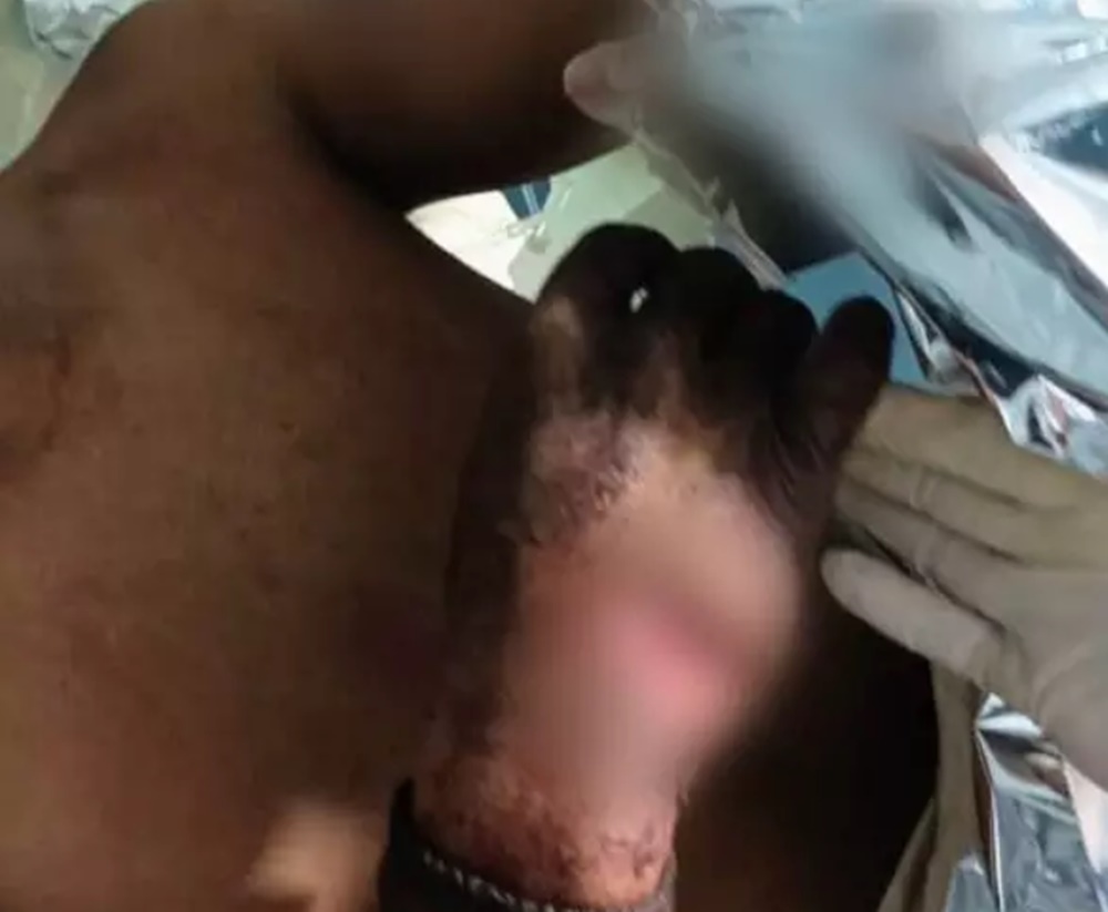 Rapaz de 22 anos tem dedos decepados durante briga de facão em festa