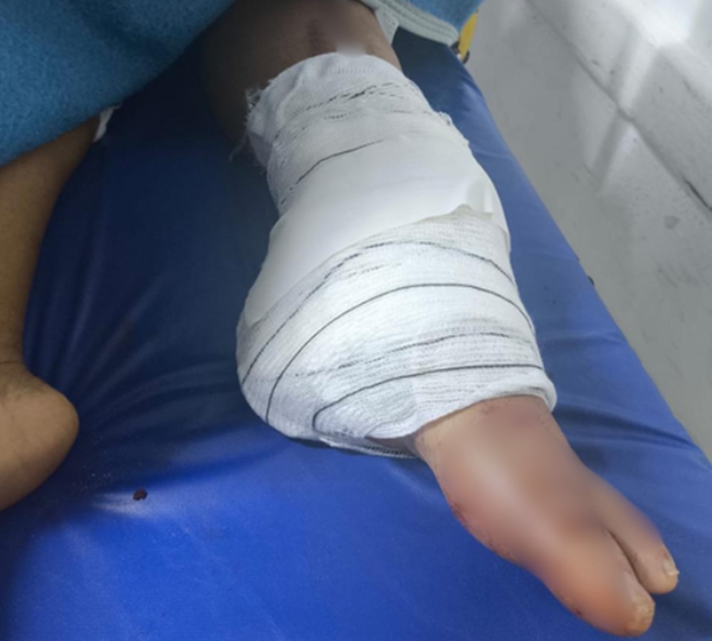 Empregada tem perna amputada e família procura motorista envolvido em acidente