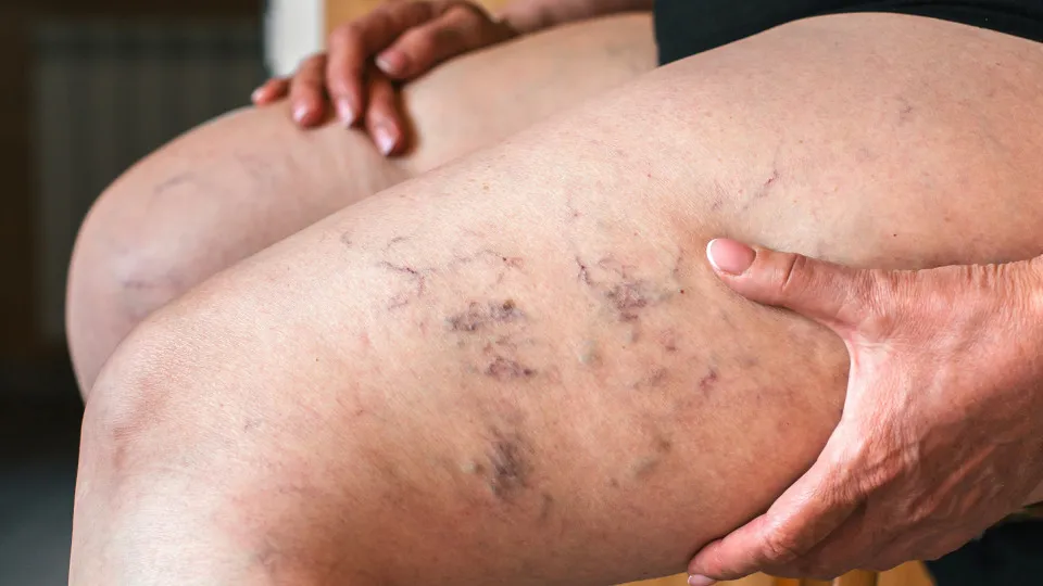 Quão perigoso é o sarampo? Sintomas para ficar de olho e como se proteger