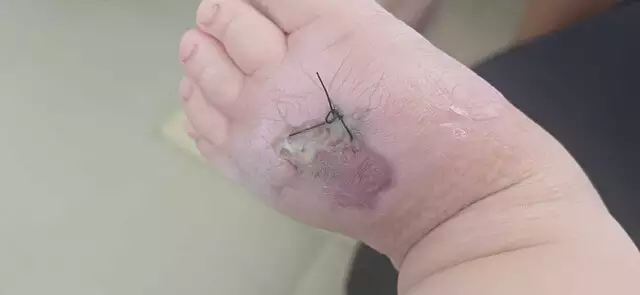 Bebê de 1 ano é internado na Santa Casa após picada de aranha e necrose no pé